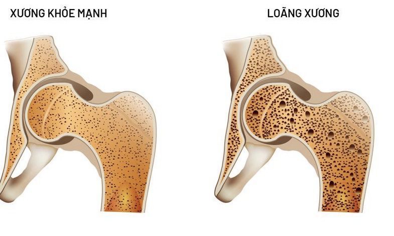 Saponin có tác dụng chống loãng xương